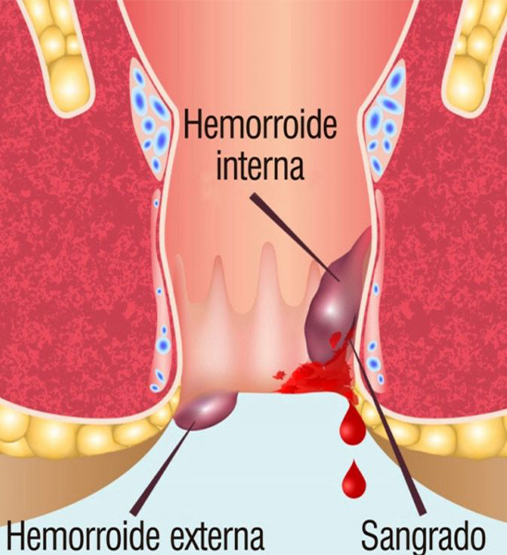 about-us-about-imghemorroide.jpg